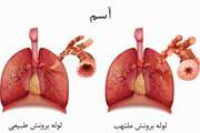 آگاهی عمومی در مورد بیماری آسم