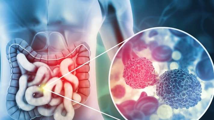 غربالگری منظم، سپری برای کاهش بروز سرطان کولورکتال